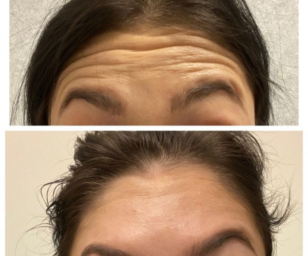 Botox.jpeg