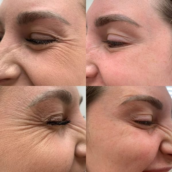 PDO-Thread-Lift-IN-NEWPORT-BEACH-Beauty-Boost-Med-Spa.jpeg
